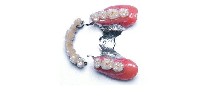 Les alternatives aux implants dentaires