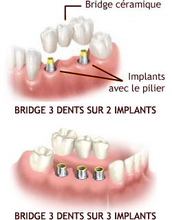 bridge-implants