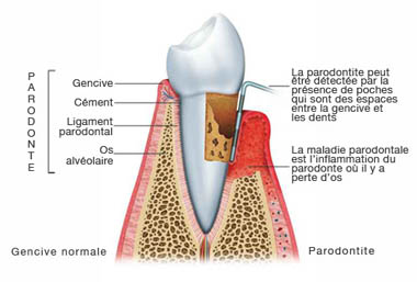 poche-parodontal