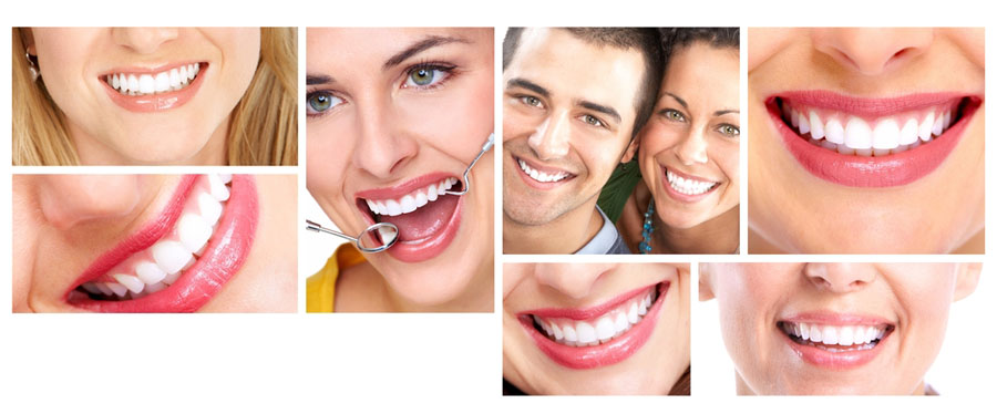 7 idées reçues sur les facettes dentaires