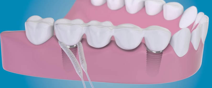 Comment nettoyer les dents sur implants dentaires?