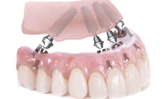 Implants dentaires All-on-4