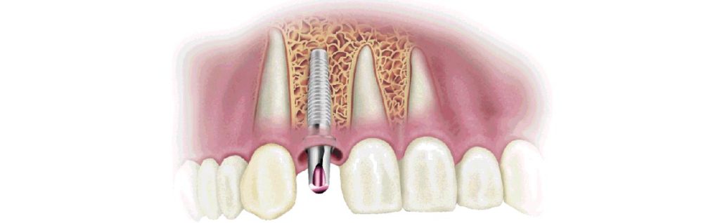 Pose de l’implant dentaire tout de suite après l’extraction