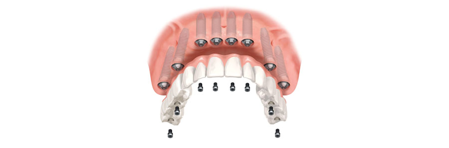 Prothèse transvissée sur implants dentaires