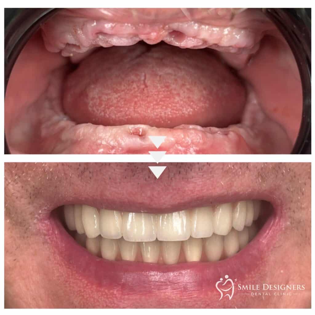 Bridge en zircone All-on-4