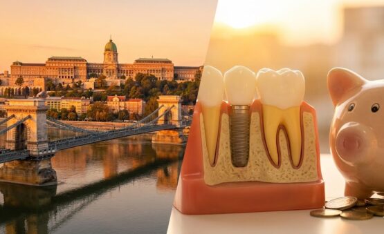 Implants dentaires prix Budapest