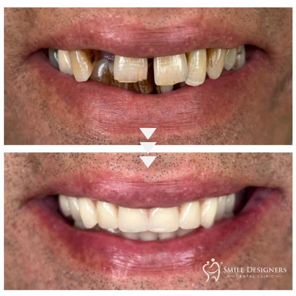 Bridge fix temporaire en resin