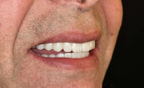 All-on-4 en zircone