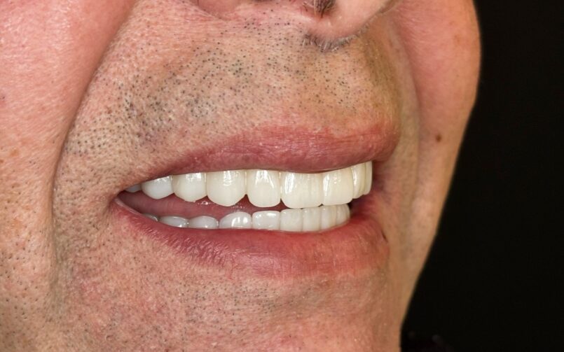 All-on-4 en zircone