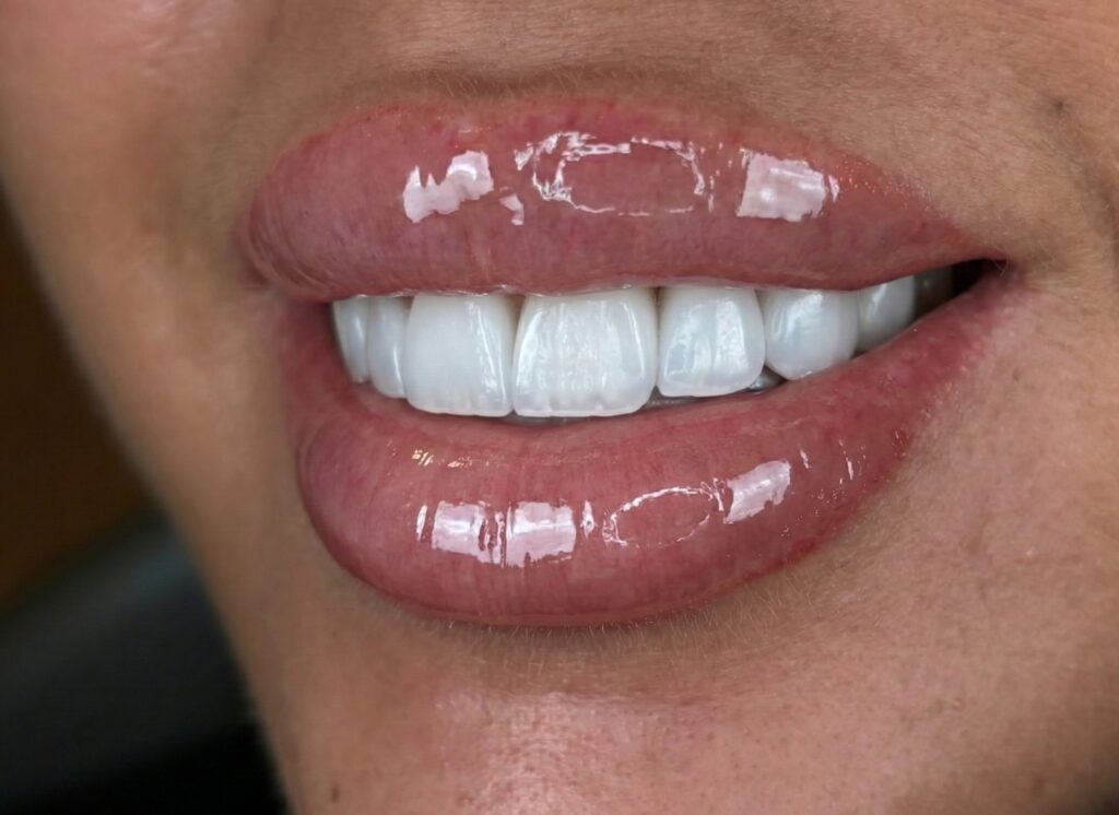 Facettes Emax BL1