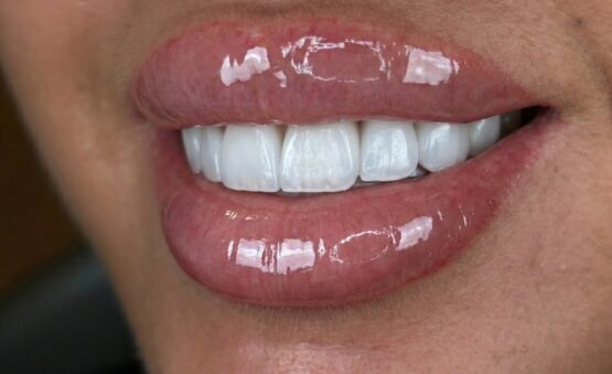 Facettes Emax BL1
