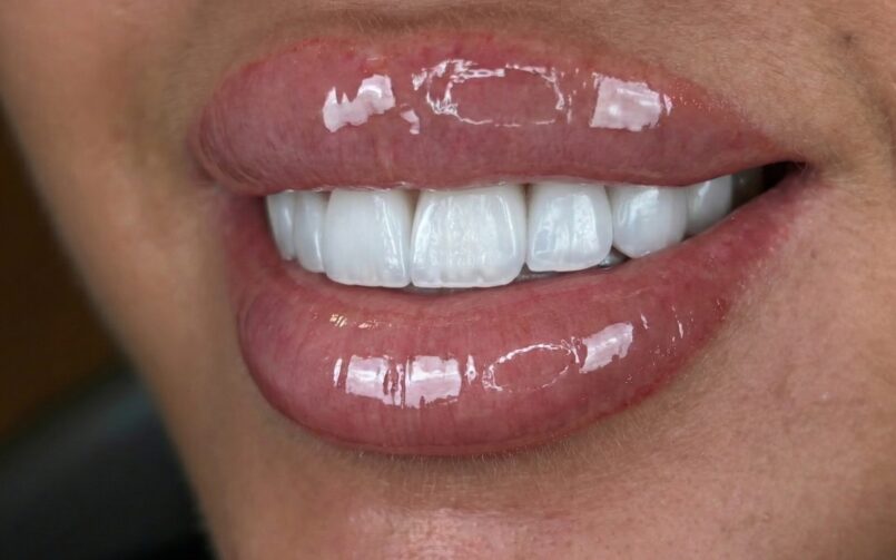 Facettes Emax BL1